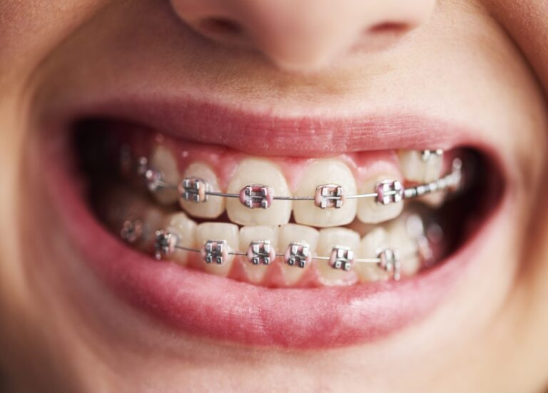 Dentist Or Orthodontist For Braces – Which Is Right For Me?