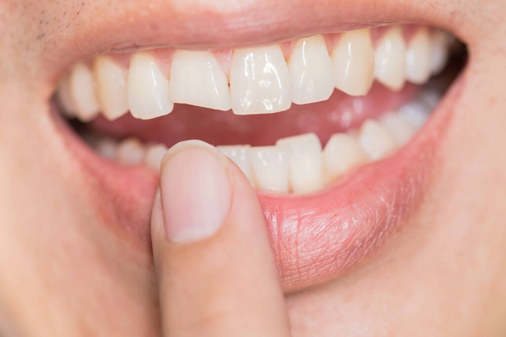 dental crown for front tooth