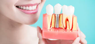 Dental Implants and Dental Care: What You Need to Know