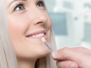 Veneers – What Are They? Veneers tallahassee fl