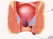 A Complete Guide to Piles: Piles Symptoms, Definition, Appearance, And More Piles Symptoms