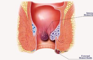 A Complete Guide to Piles: Piles Symptoms, Definition, Appearance, And More Illustration of hemorrhoid symptoms and the affected area