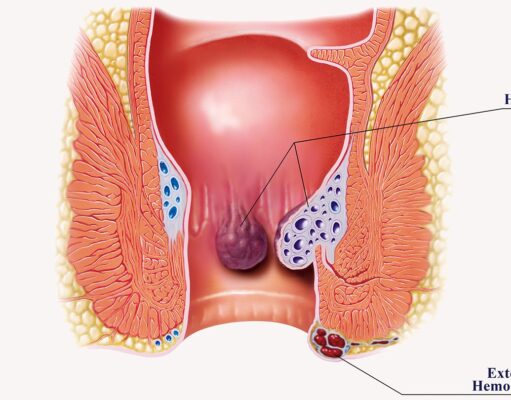 A Complete Guide to Piles: Piles Symptoms, Definition, Appearance, And More Piles Symptoms