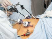 How Gastric Bypass Surgery Can Help You Achieve Sustainable Weight Loss gastric bypass surgery