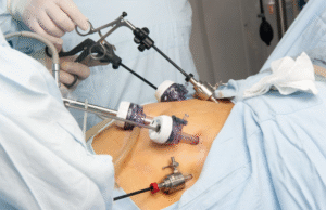 How Gastric Bypass Surgery Can Help You Achieve Sustainable Weight Loss gastric bypass surgery